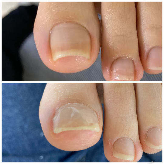 江戸川区船堀駅近くで巻き爪と割れ爪の矯正 おざわ整骨院 巻き爪・割れ