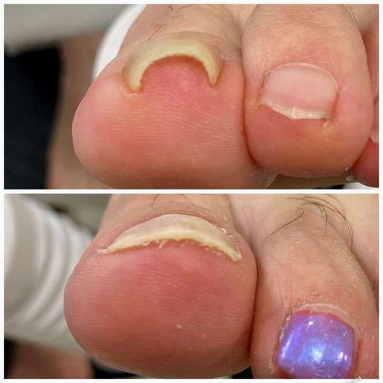 江戸川区船堀駅近くで巻き爪と割れ爪の矯正 おざわ整骨院 巻き爪・割れ