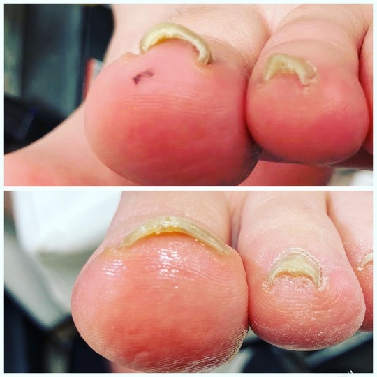 江戸川区船堀駅近くで巻き爪と割れ爪の矯正 おざわ整骨院 巻き爪・割れ