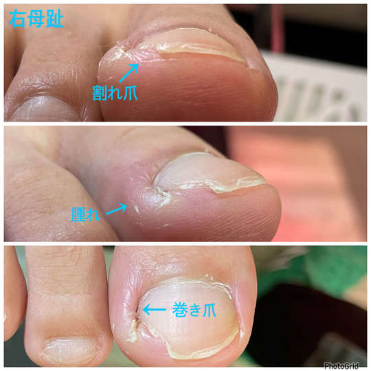 割れ爪補正施術の症例 - 江戸川区船堀駅近くで巻き爪と割れ爪の矯正